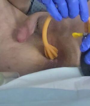 Belly Inflation Anal Enema Medical