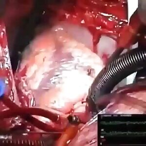 Shocking A Heart Back Into Proper Rhythm