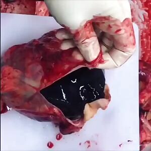 Sudden death due to Left Ventricular Free Wall Rupture