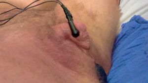 Electrostimulation Big Clit Buttplug Electro Orgasm
