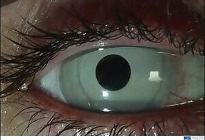 Removing a cosmetic iris implant.