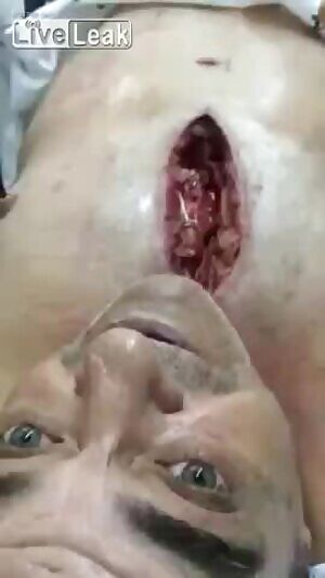 Man with a gaping hole in his chest having a conversation with a nurse in the hospital