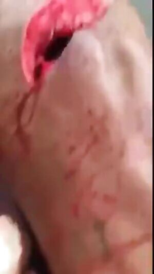 Slash across chest exposes lung