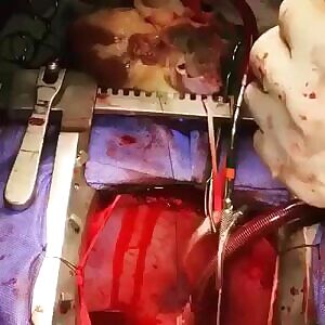 Heart Transplant