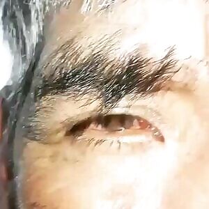 Massive Intraocular Melanoma