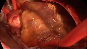 Removing a large thrombosis from the pulmonary artery